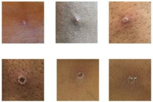 Stages of Monkeypox Lesions